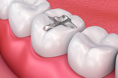 Fort Des Moines Dental | Dental Fillings, Dental Cleanings and Dental Bridges