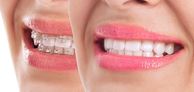 Fort Des Moines Dental | Night Guards, Implant Dentistry and Dental Cleanings
