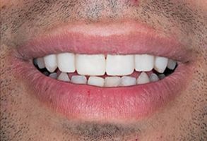 Fort Des Moines Dental | Dentures, Emergency Treatment and Dental Cleanings